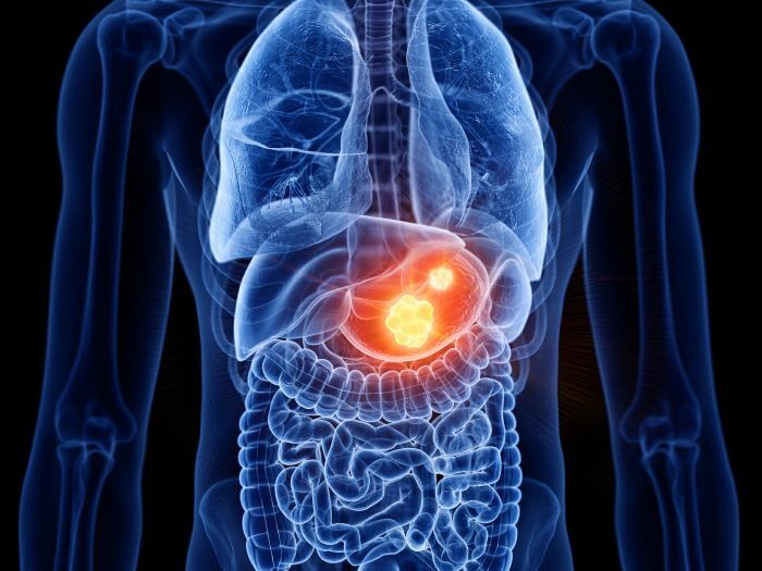 CÂNCER GASTROINTESTINAL: DESAFIOS DIAGNÓSTICOS E ESTRATÉGIAS TERAPÊUTICAS ATUAIS